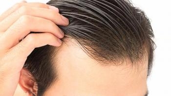 Hair Transplant