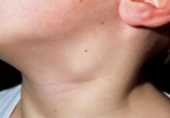 Deep Neck Infection