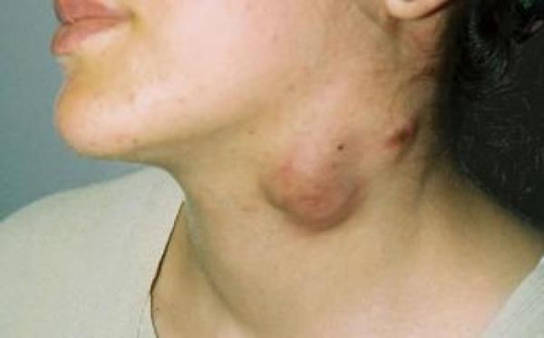 Inflammatory swellings in the neck