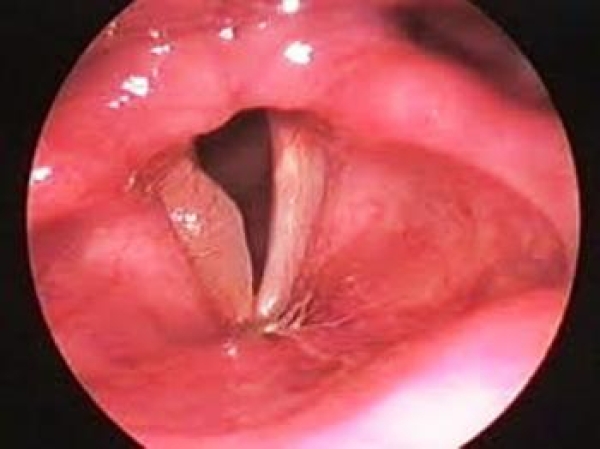 Vocal Cord Paralysis